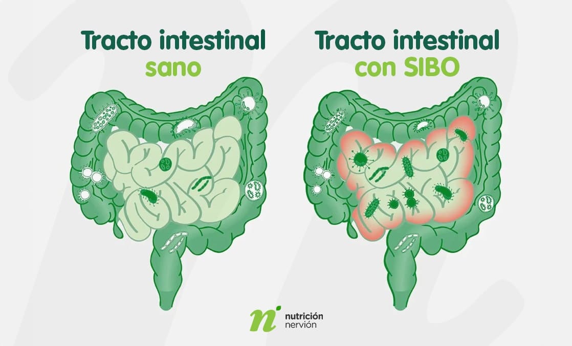 Diferencia del tracto intestinal sano y con SIBO